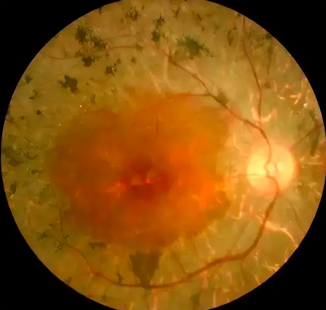 夜间视力下降?警惕视网膜色素变性