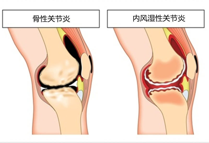 类风湿性关节炎和骨性关节炎，不要再分不清了，医生教你分辨
