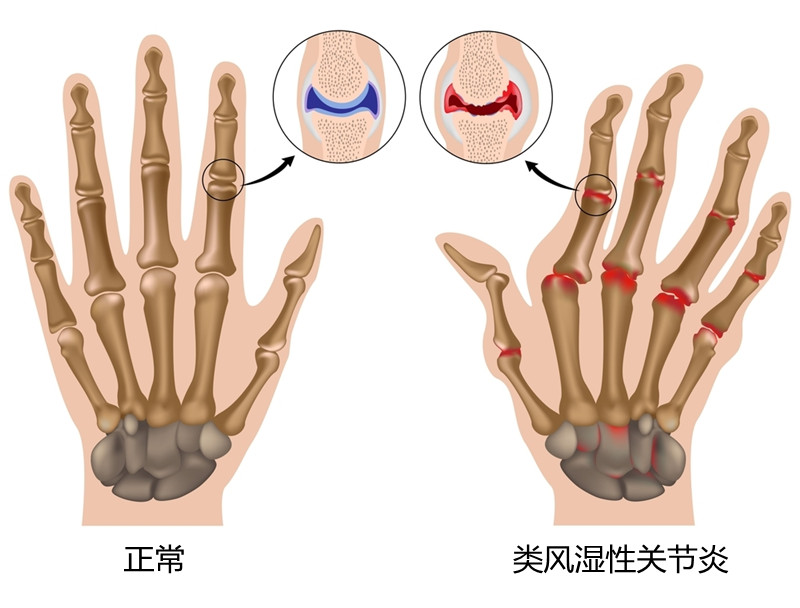 类风湿性关节炎和骨性关节炎，不要再分不清了，医生教你分辨
