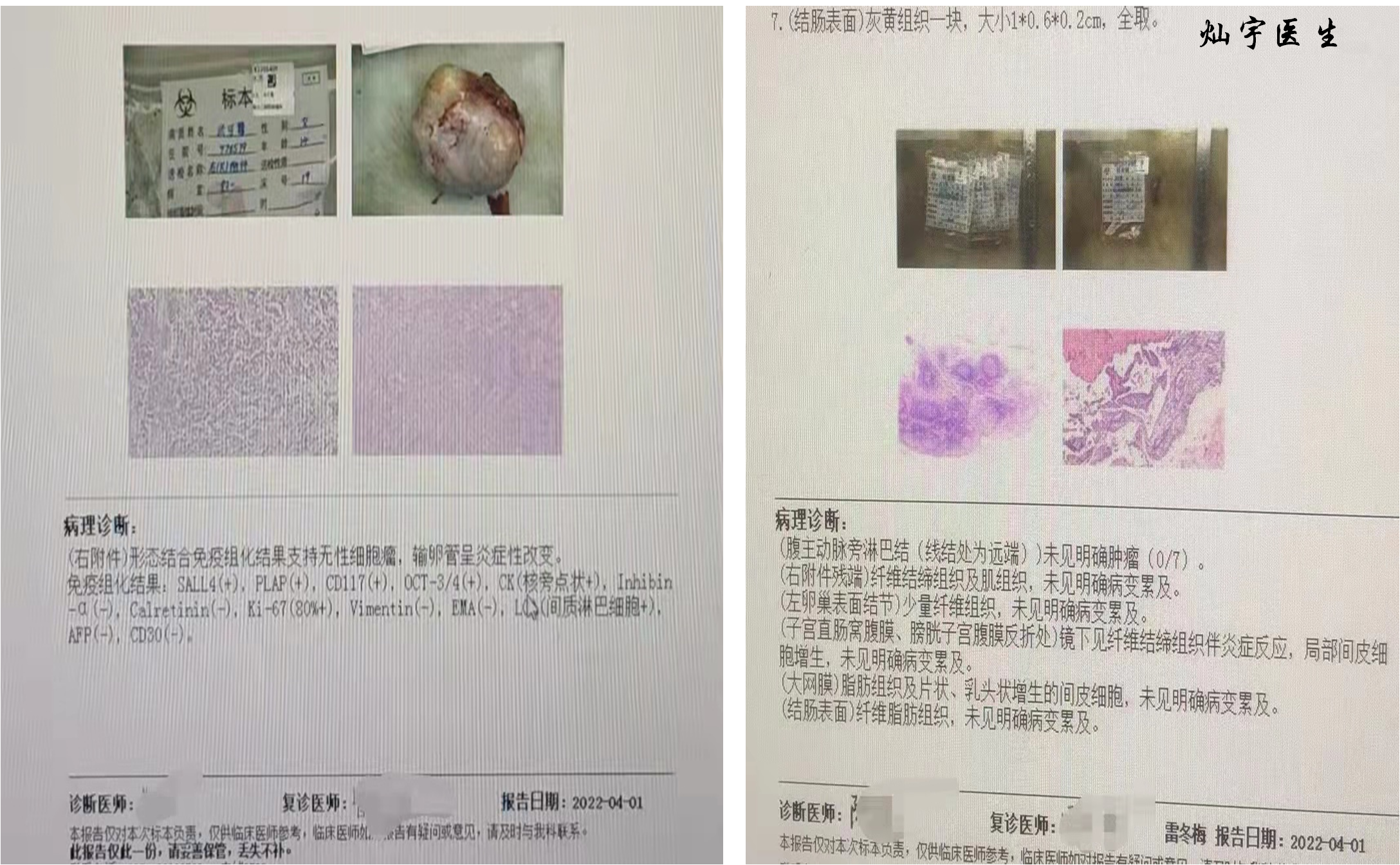 术后病理.png