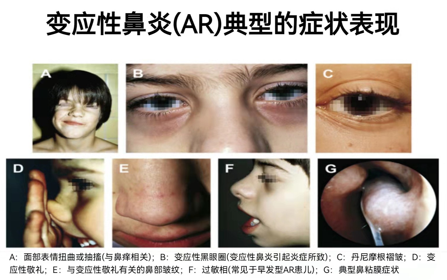 变应性鼻炎图片.jpg