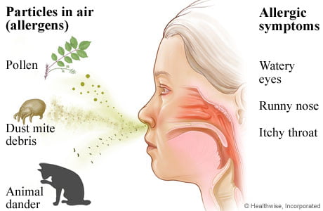 allergicrhinitis-1.jpg
