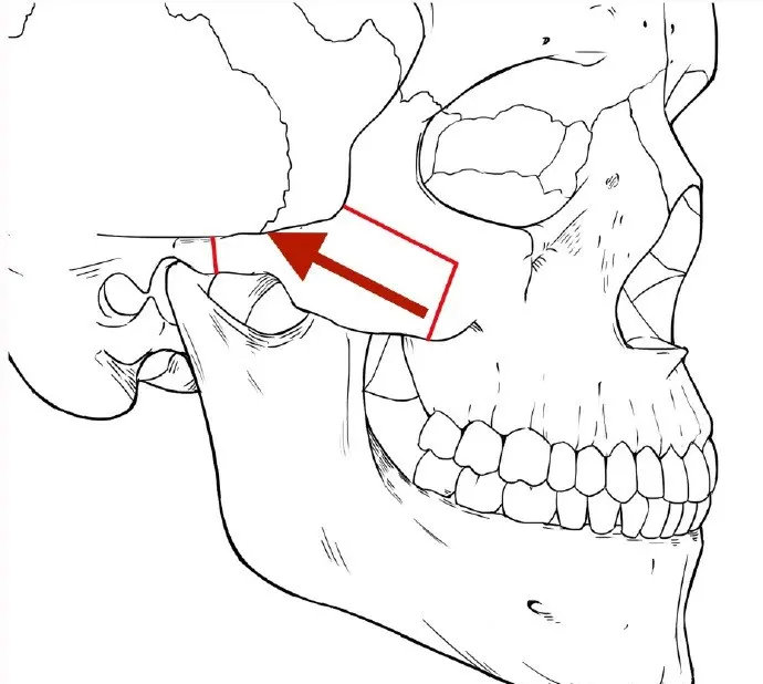 颧骨内推示意图图片