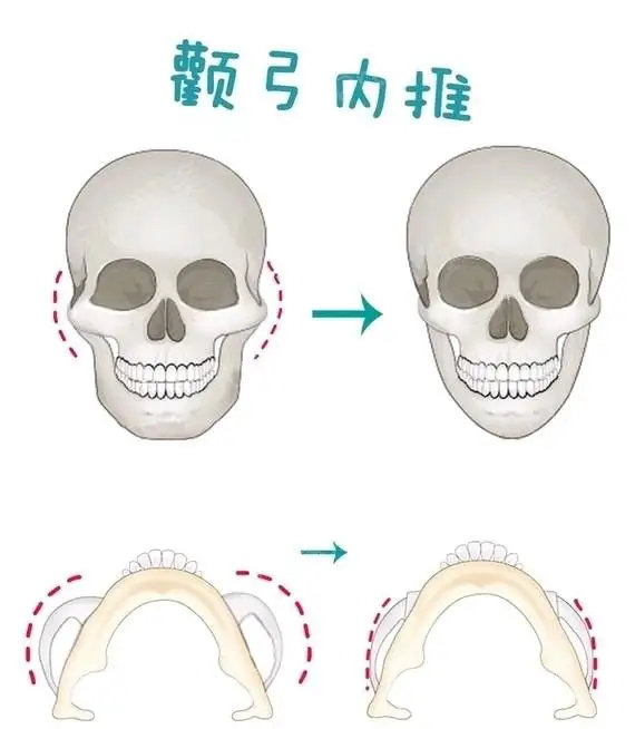 磨骨瘦脸手术中的颧弓内推手术;其本质是缩小颧骨 截断并内