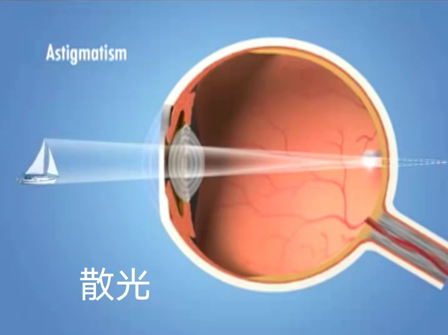 散光是什么?