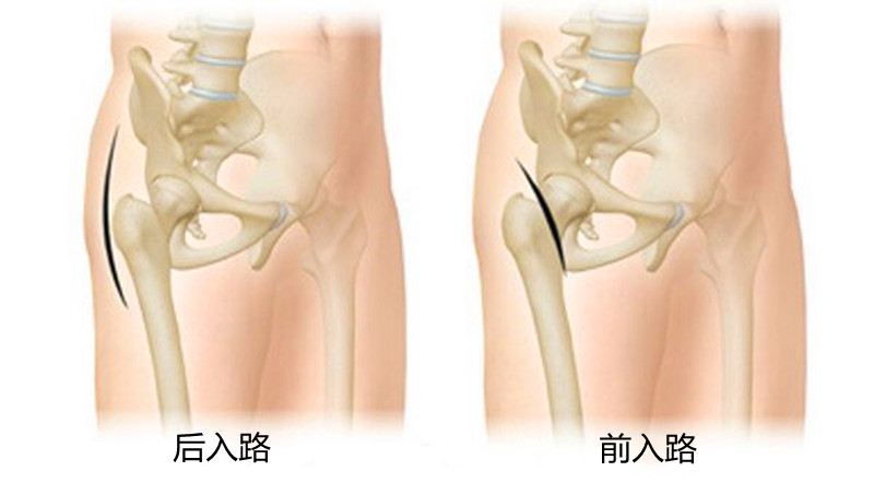 人工髋关节置换，后入路和前入路，哪种手术方式恢复得快？