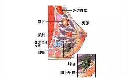 乳腺纤维瘤.png
