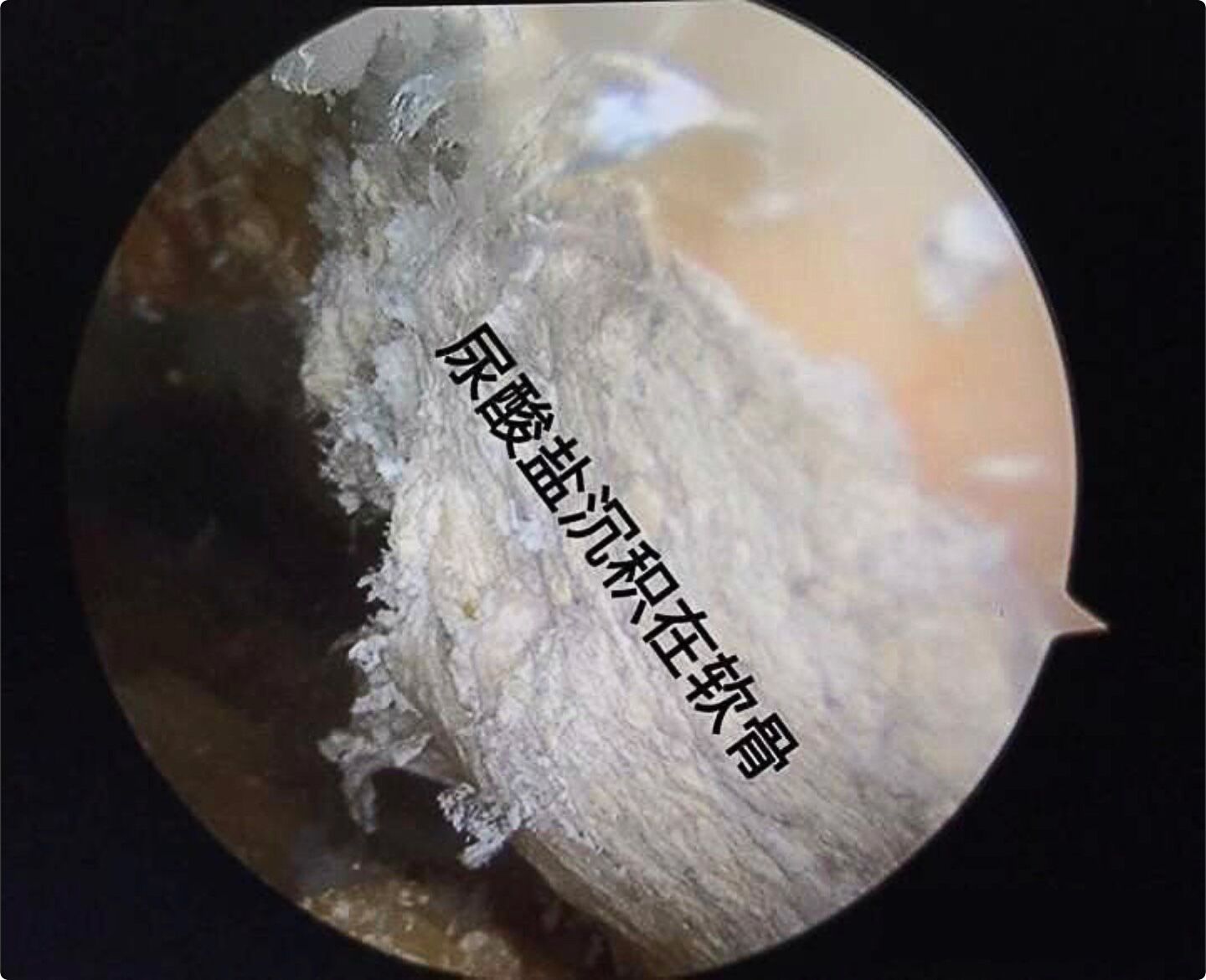 痛风结晶拍片显示 (3).jpg