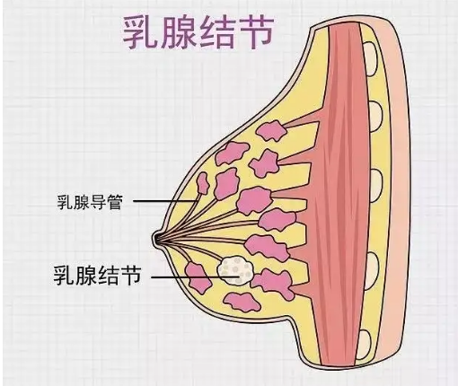 乳腺结节.png