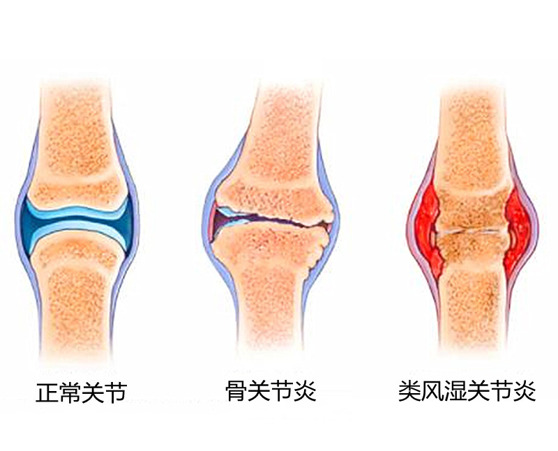 骨质疏松症与骨关节炎，别混淆了，同时都有怎么办？