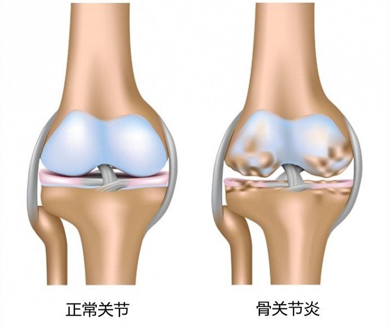 骨质疏松症与骨关节炎，别混淆了，同时都有怎么办？