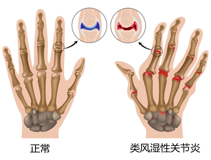 如何辨别痛风和类风湿性关节炎，哪个更难治？