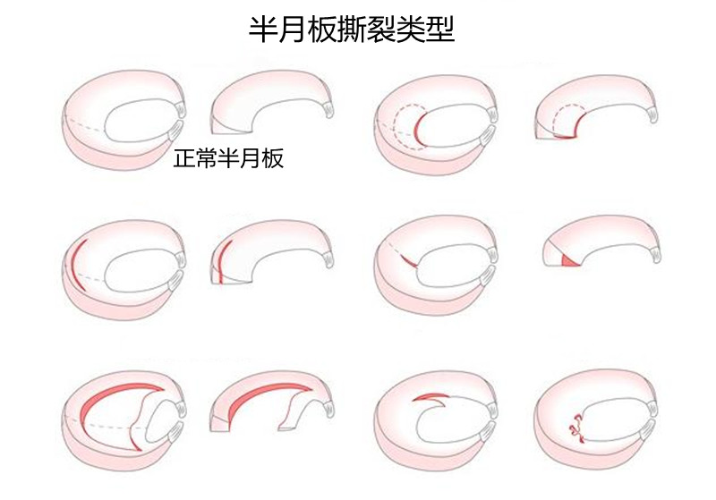 一个小动作，膝盖疼痛难忍，什么是半月板退行性撕裂？