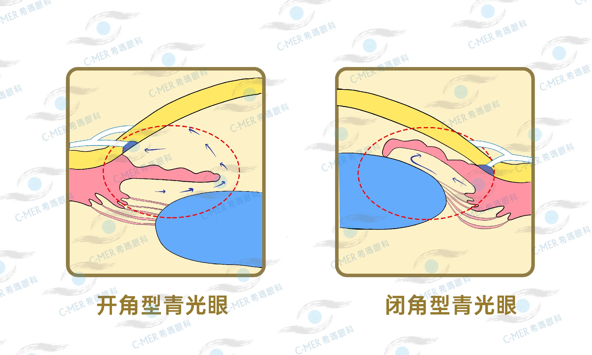 一天八杯水，小心引发致盲性眼病！