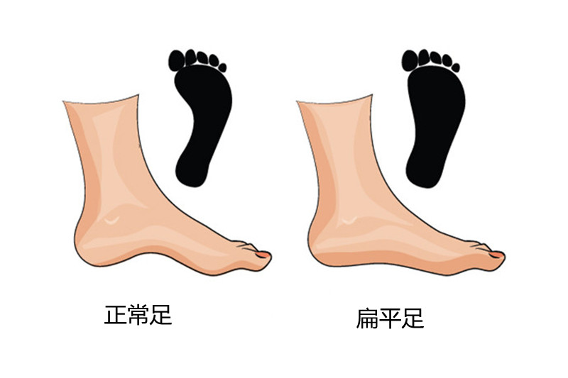 莫名其妙的腰酸腿疼，看鞋底就知道原因