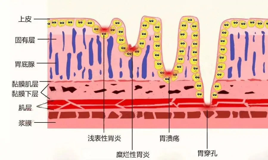 消化性溃疡病因图片