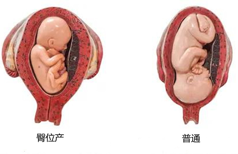 一条腿长一条腿短，容易被忽视的髋关节发育不良