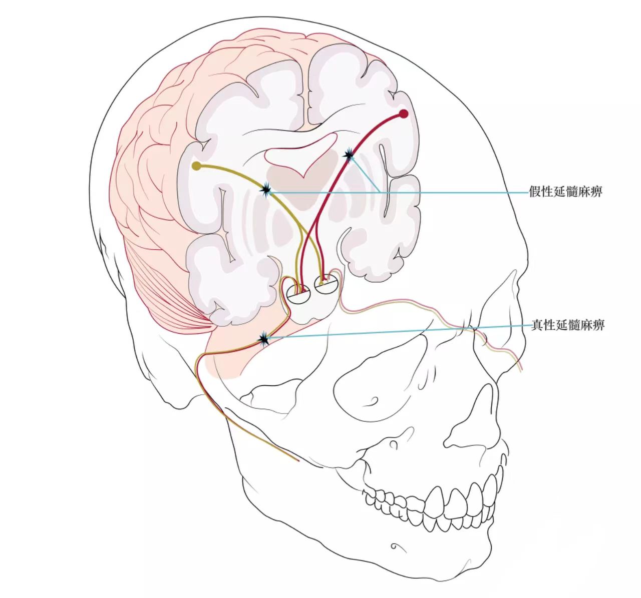 真,假性延髓麻痹-健康160