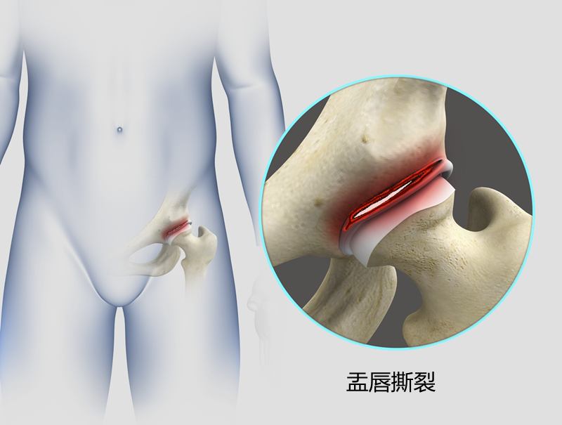腹股沟疼痛容易被误诊，问题可能出在盂唇撕裂