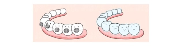青少年正畸攻略 | 儿童早期矫治可以戴隐形牙套吗？