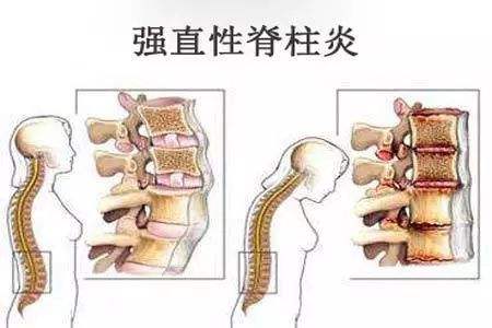 强直.jpeg