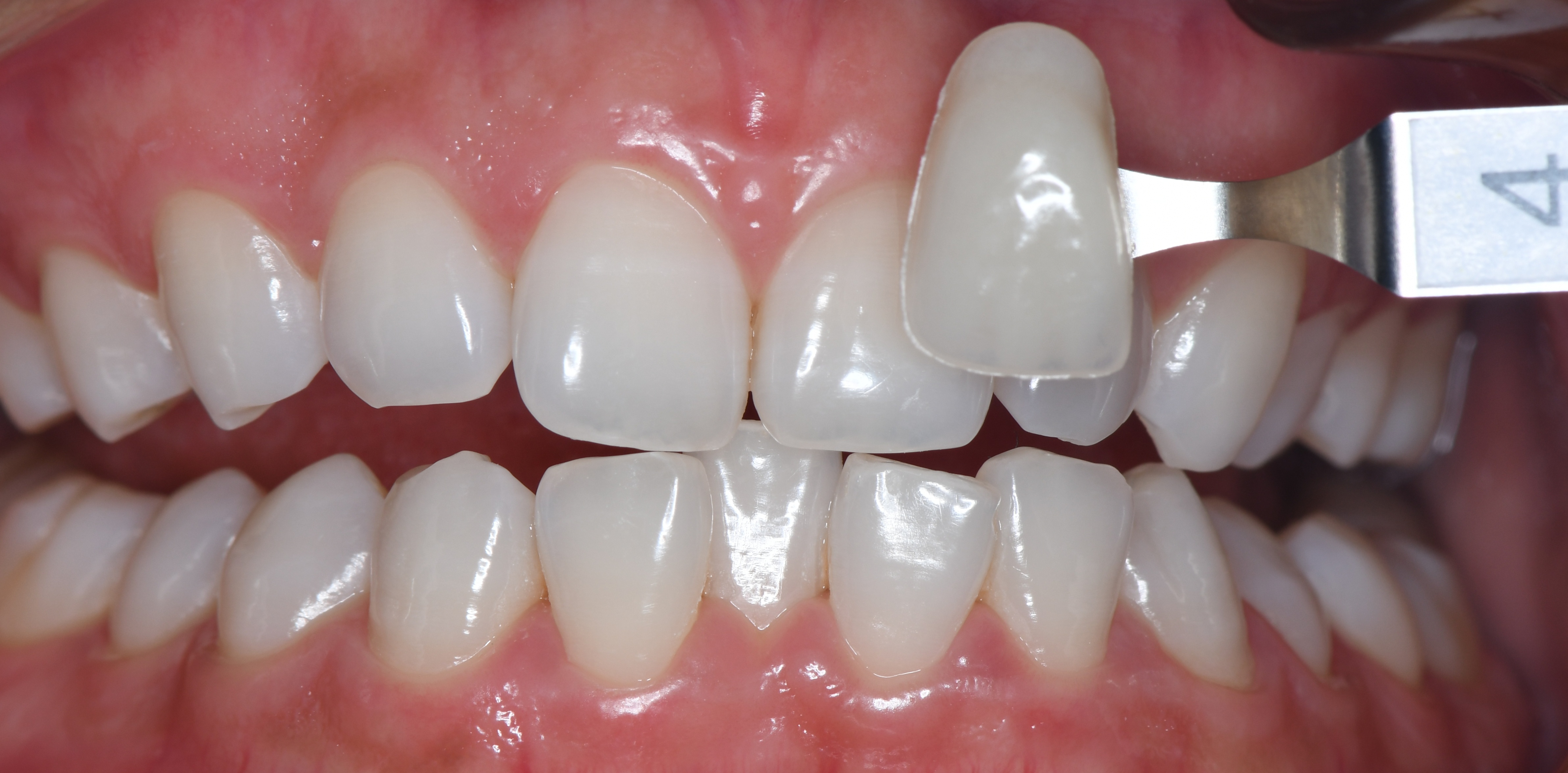 全口皓德士牙齿美白案例-健康160