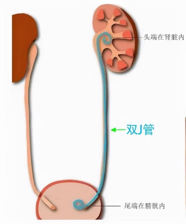 输尿管双j管置入图片图片