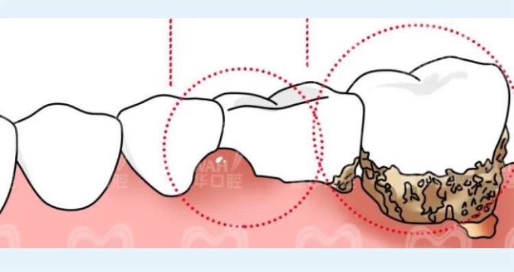 主要是因为牙周炎导致牙周组织遭到牙龈萎缩破坏,牙槽骨吸收以后,附着