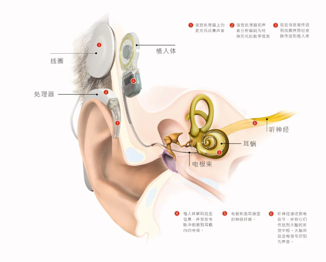 电子耳蜗：先天性耳聋患儿的福音