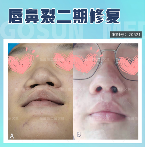 双侧唇裂鼻修复