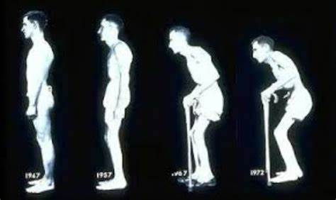 Ankylosing Spondylitis: Identifying the signs, diagnosis and treatment ...