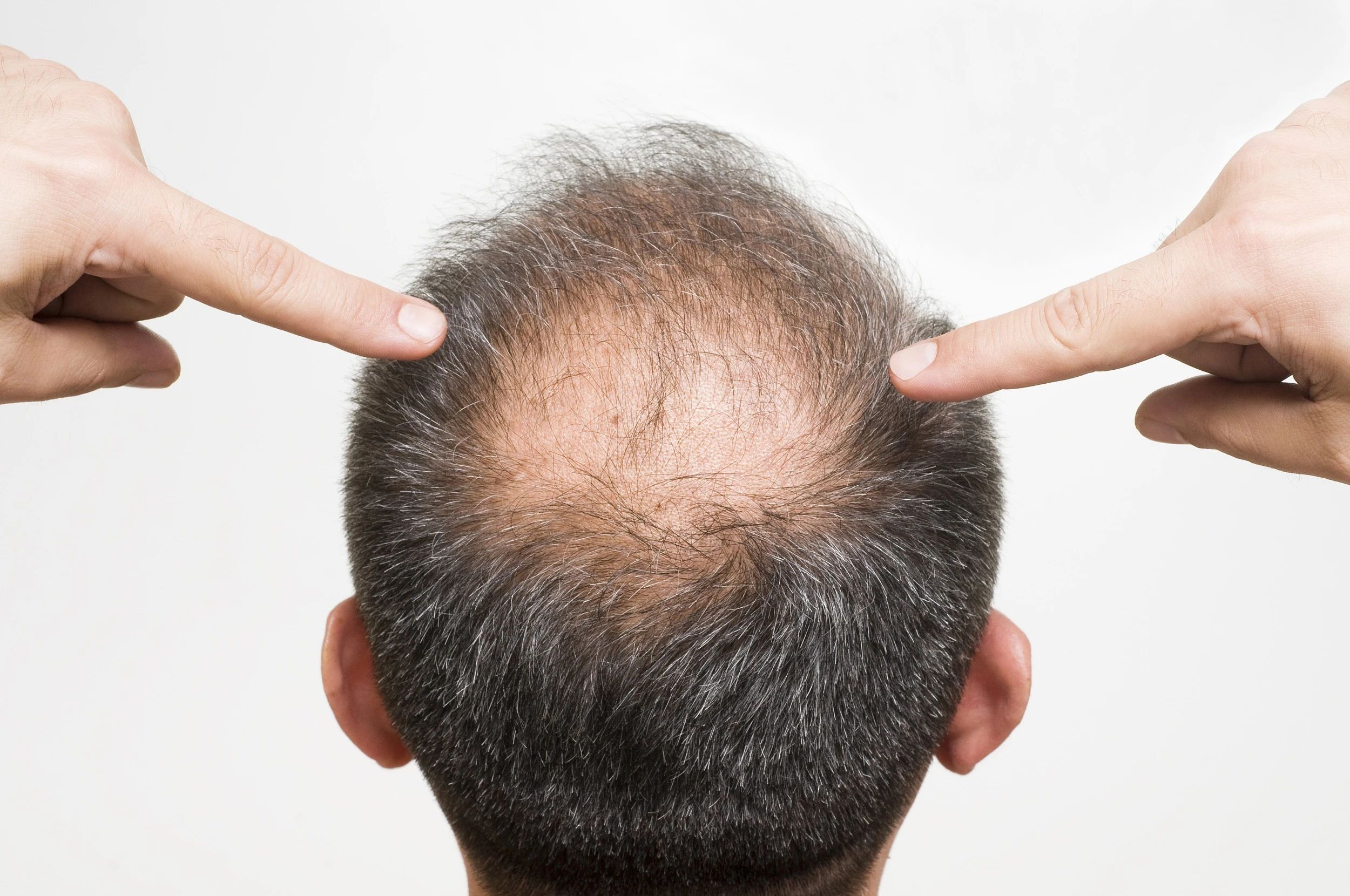 雄性激素脱发怎么治（雄性激素脱发如何治疗？） | 说明书网
