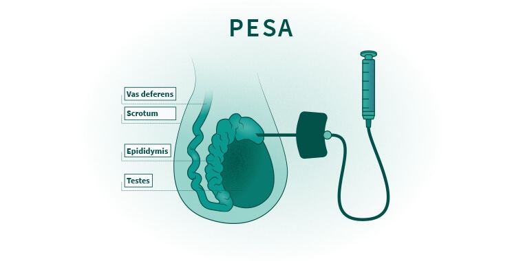 Fertility treatment for men