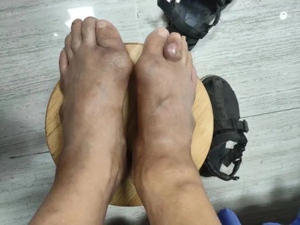 痛风发作影响行走，患者应该怎么做？