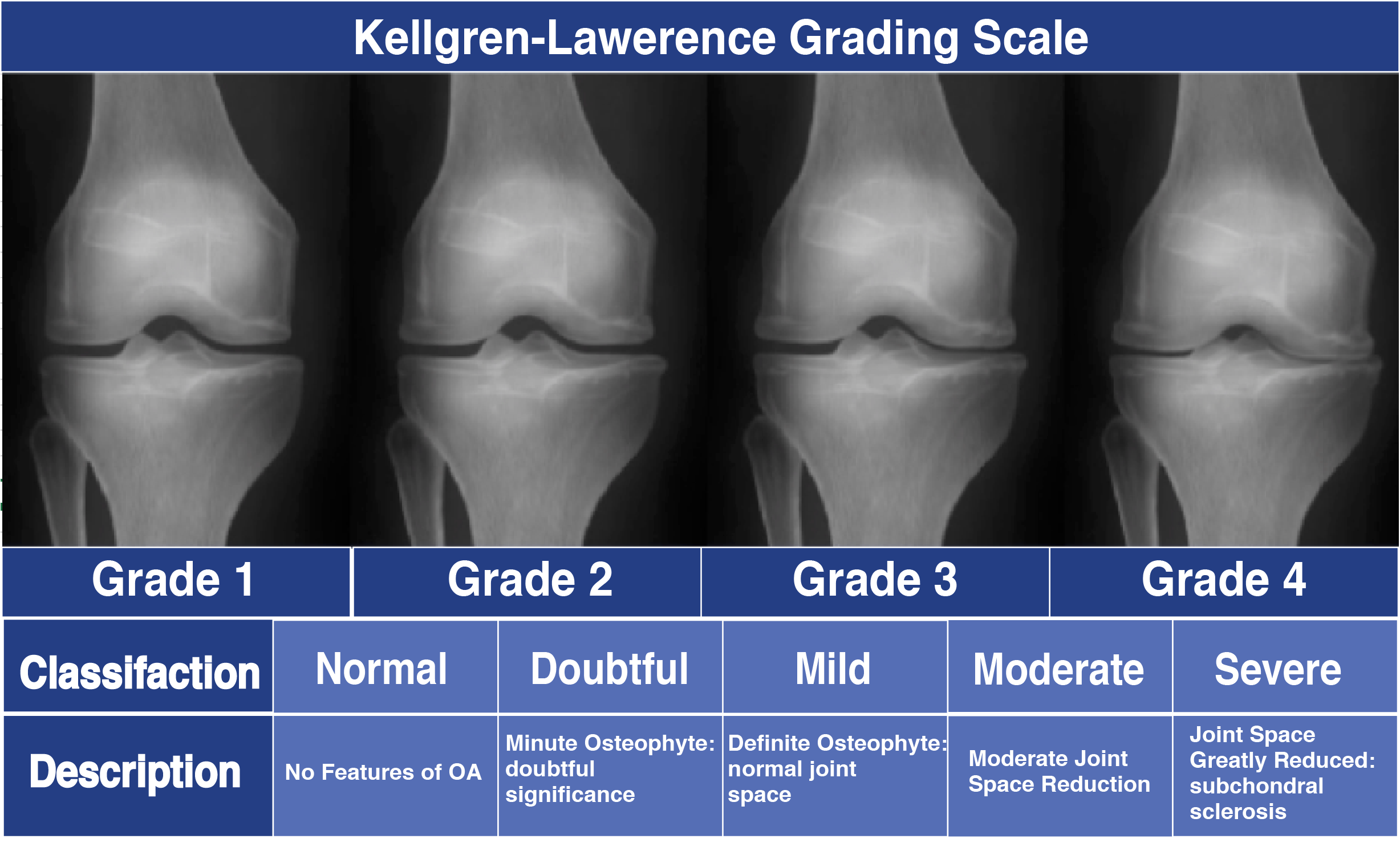 Guide to Severe Knee Arthritis (Osteoarthritis) - Spring Loaded Technology