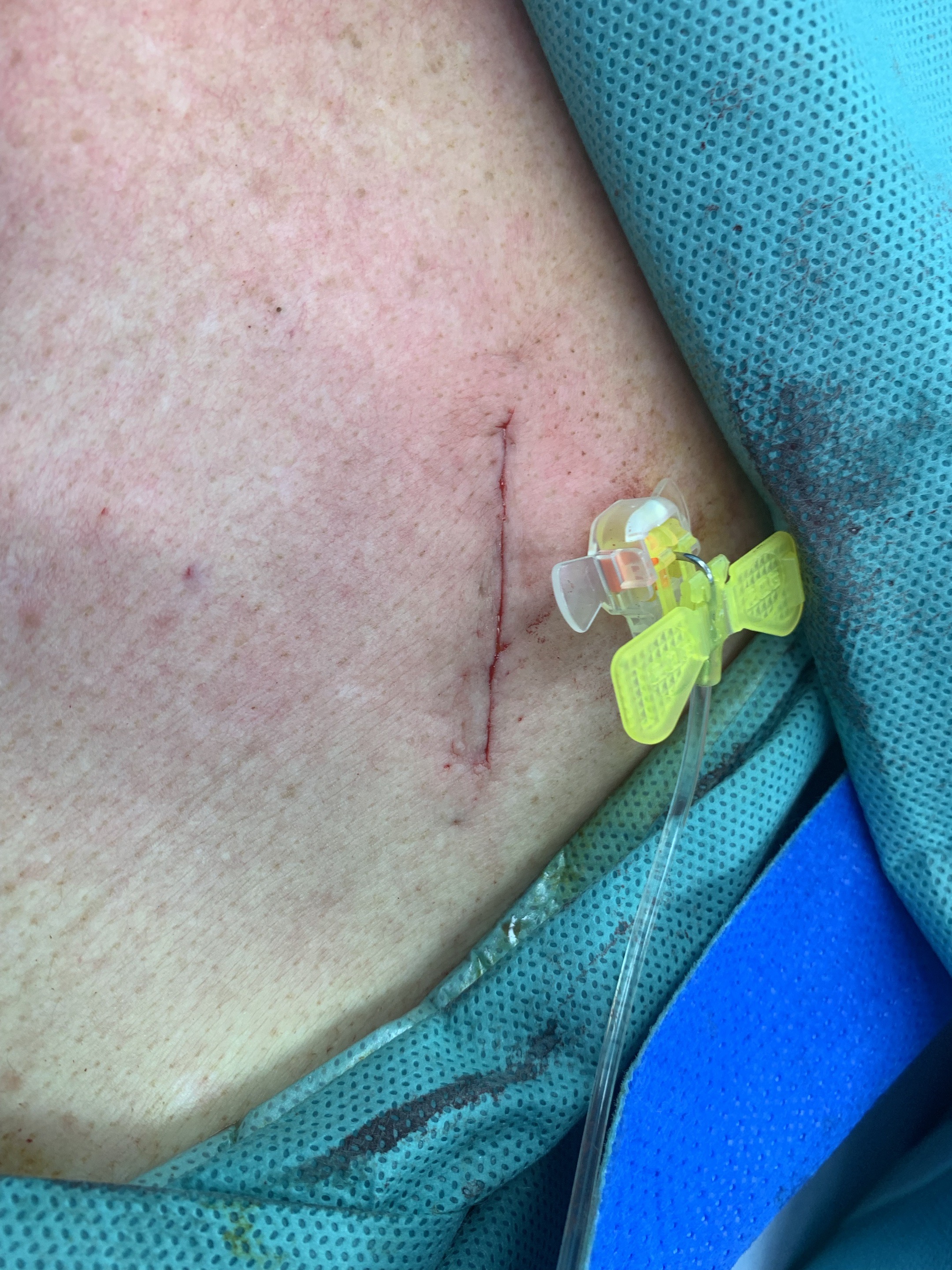 缝针疤痕相关科普资讯