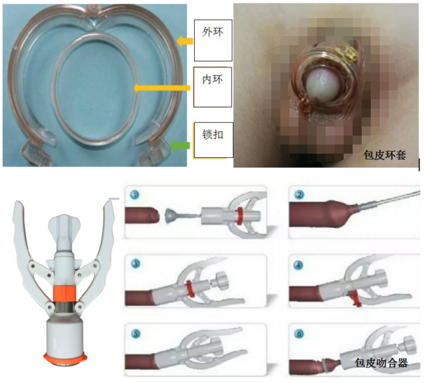 儿童包皮那些事儿 小儿包茎 包皮过长的诊治