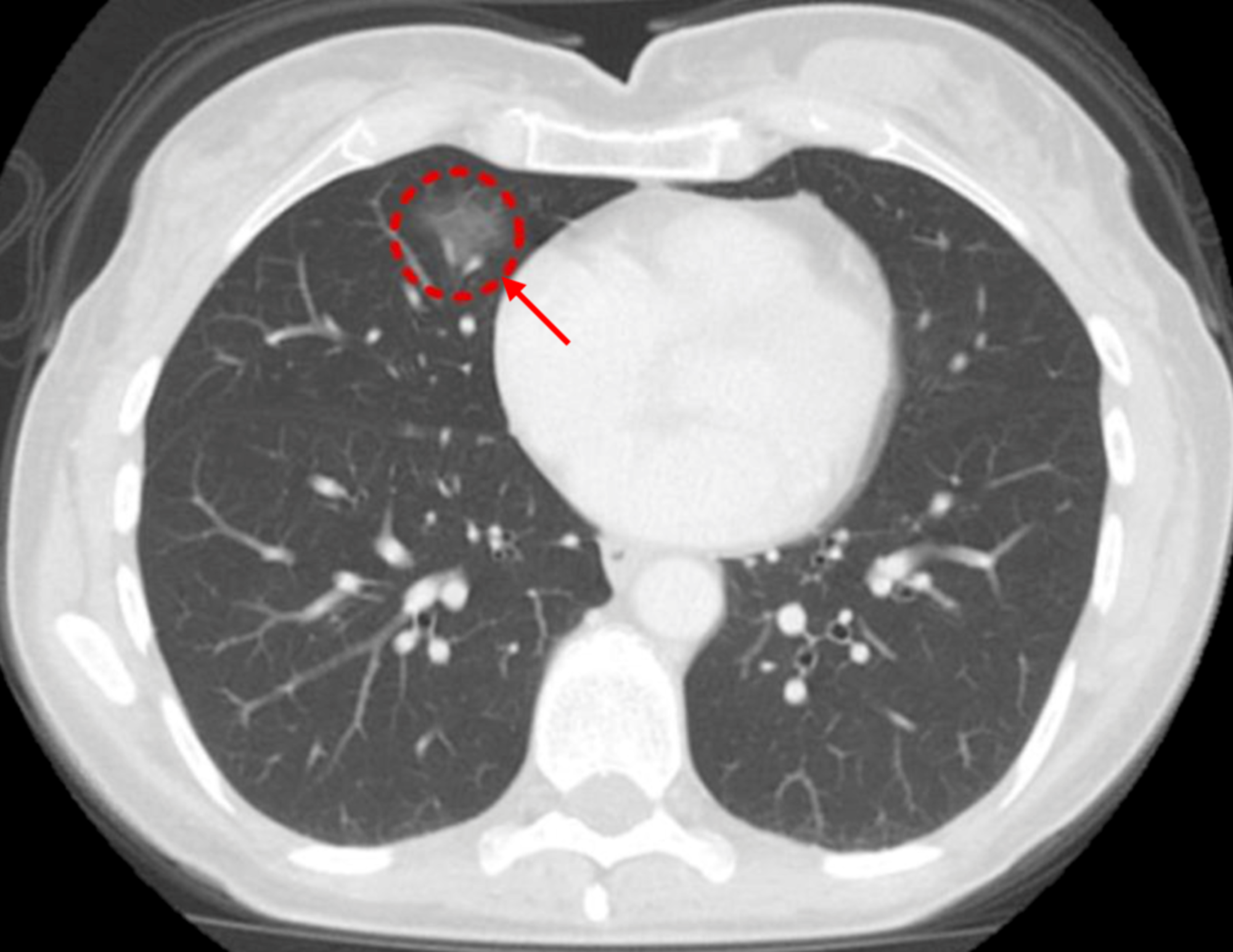 What Is Ground Glass Opacity Lung Nodules - Glass Designs