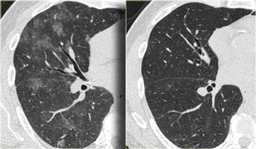 The Radiology Assistant : HRCT - Common diagnoses