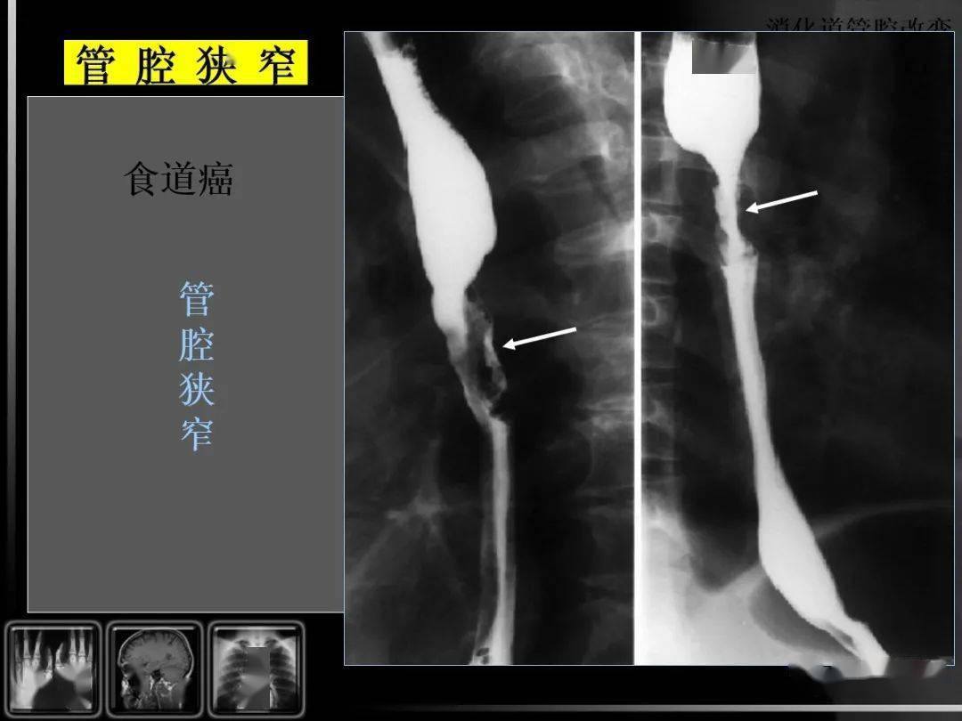 【汇总】消化道疾病影像诊断与鉴别_造影