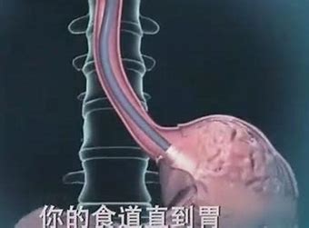 Image result for 胃镜检查