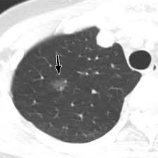 Pure Ground-Glass Opacity Neoplastic Lung Nodules: Histopathology, Imaging,  and Management | AJR