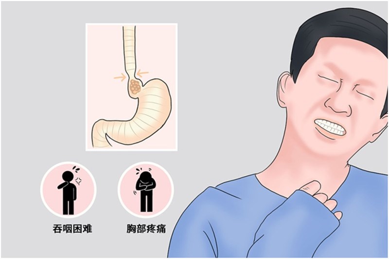 吞咽困难可能是患上了贲门失迟缓-我院仙葫脾胃肝病科成功开展POEM手术-前沿技术-新闻中心-广西中医药大学第一附属医院|广西中医药大学第一临床 ...