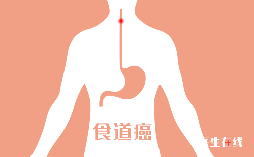 确诊食道癌可以做什么检查_肿瘤_医生在线