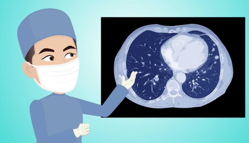 肺内的磨玻璃结节到底是什么？是癌症么？ - 海报新闻