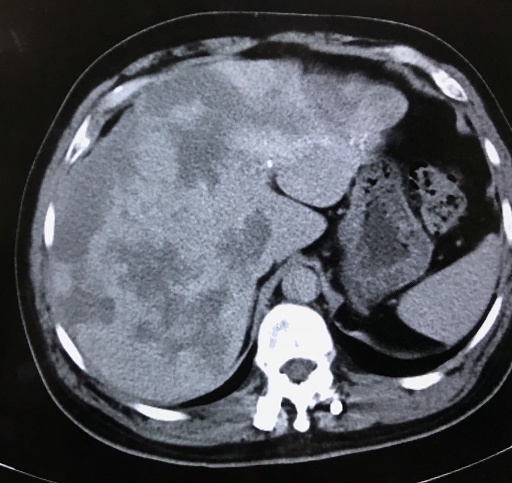 孩子肝功能异常相关科普资讯