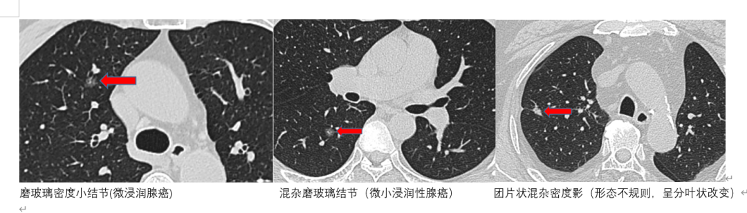 查出肺结节要不要紧？关键先看这 3 点！
