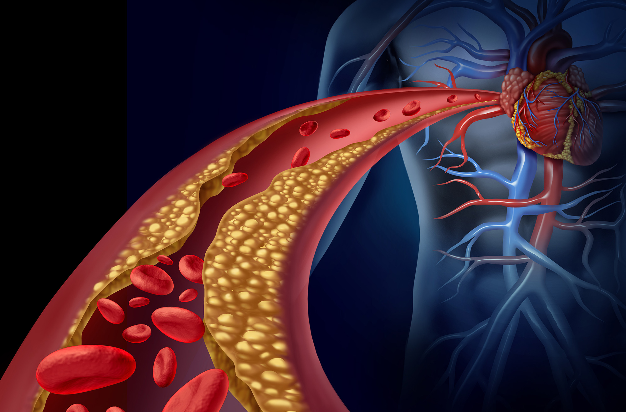 Heart Attack - Symptoms and Causes