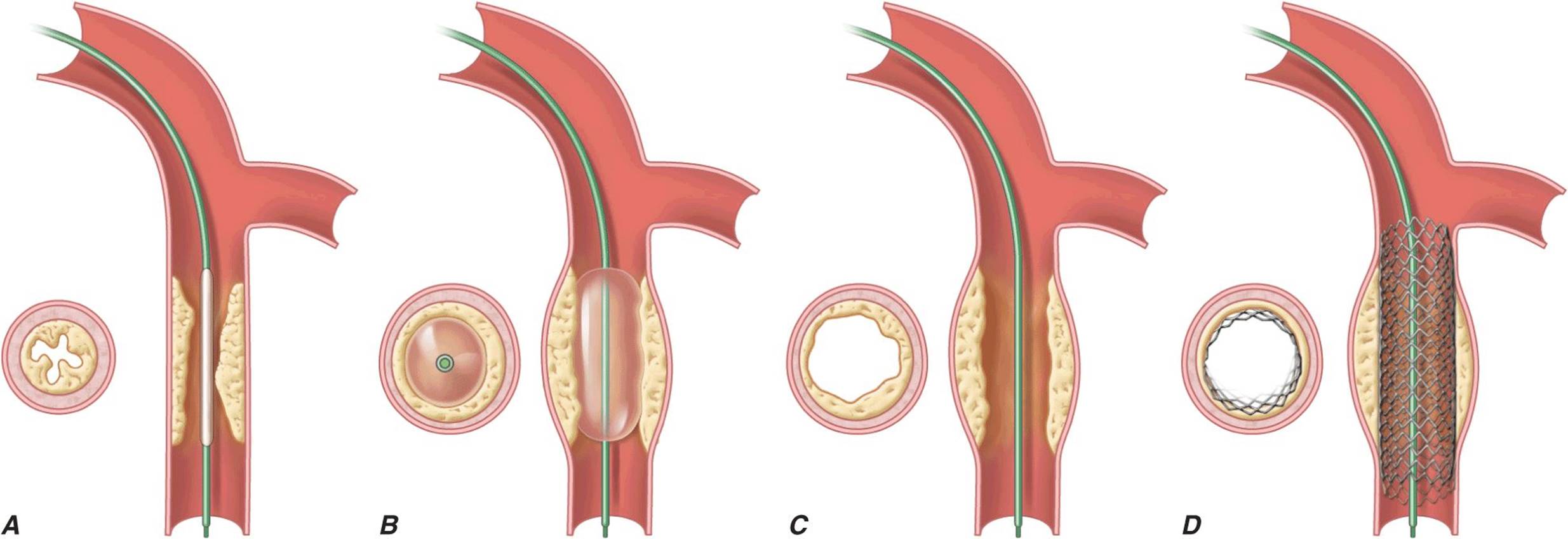 PERCUTANEOUS CORONARY INTERVENTIONS AND OTHER INTERVENTIONAL PROCEDURES ...