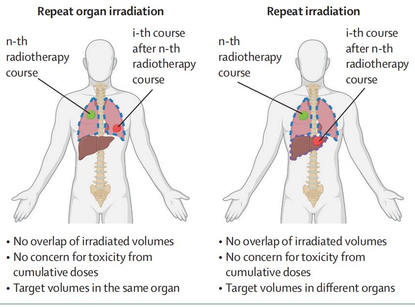 器官重复照射及重启新放疗.jpg